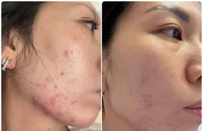 Testimonial — ~6 weeks result (she's 45)